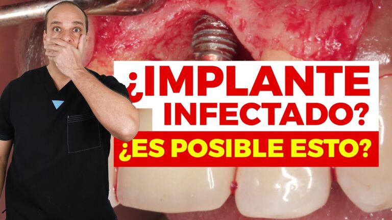 Infección en los implantes dentales: Causas y tratamiento